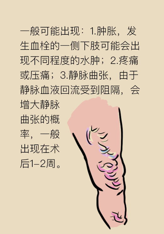 弹力袜对下肢血栓有什么帮助,预防下肢静脉血栓弹力袜注意事项