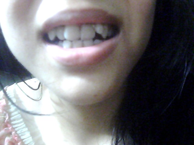 有虫牙可以正畸吗,虎牙齿可以矫正吗