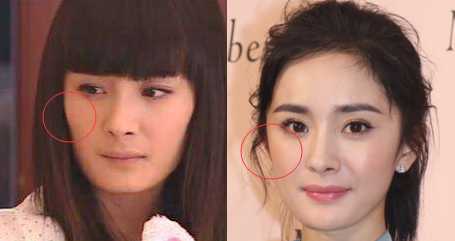 颧骨高填充好还是磨骨,颧骨高自体脂肪填充