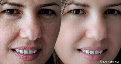 二十岁被叫阿姨还不是因为你脸上的皱纹！别急，还有机会救回来