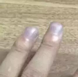 指甲出现哪些症状是有问题的,指甲上有皱纹有什么信号求救