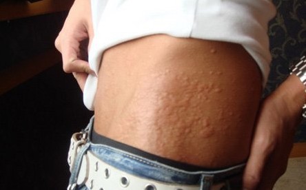 花粉过敏打喷嚏眼睛痒用什么药,花粉过敏最佳中医治疗方法