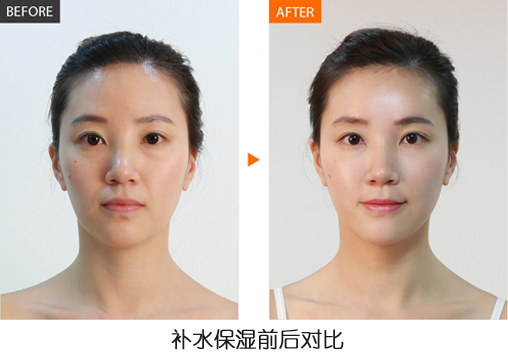 打玻尿酸的明星,为什么明星都要打玻尿酸