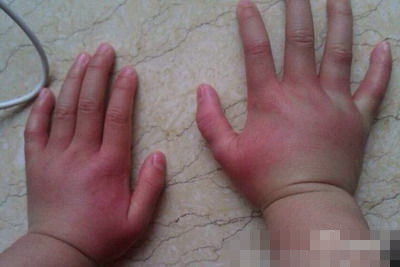 宝宝手被蚊子咬了起水泡怎么回事,小宝宝被蚊子咬了一个大包怎么办