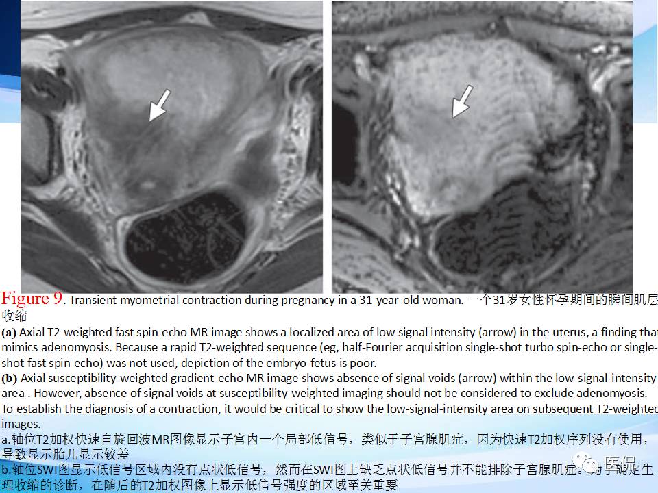 双语PPT：子宫腺肌症常见和不常见的MRI表现医学影像