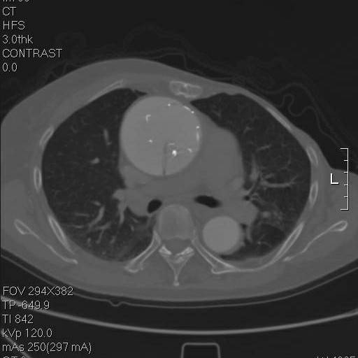 主动脉夹层袭来的恐慌,你不懂