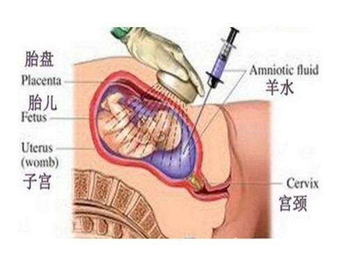 绒毛穿刺会对胎儿发育造成影响吗,绒毛穿刺致胎儿畸形吗