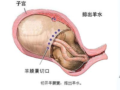 剖腹产全过程,剖腹产20天伤口真实照片