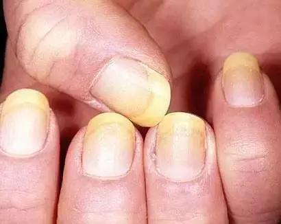 指甲出现哪些症状是有问题的,指甲上有皱纹有什么信号求救