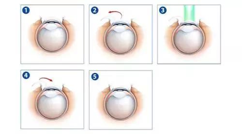 4种近视眼手术哪个最靠谱,成都近视眼手术价格一览表