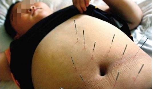 针灸怎样治疗高脂血症？