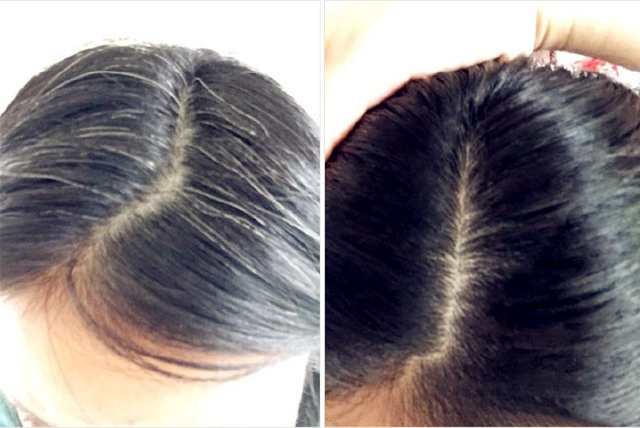 怎么知道少白头是由疾病引起的,男生少白头是什么原因造成的