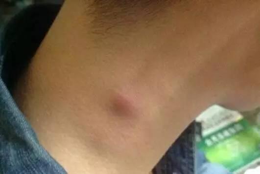 脖子发胀难受怎么回事怎么调理,脖子出现这三种特征可能已患大病