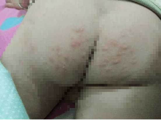 宝宝起湿疹可以接种疫苗吗,宝宝湿疹什么程度不能接种疫苗