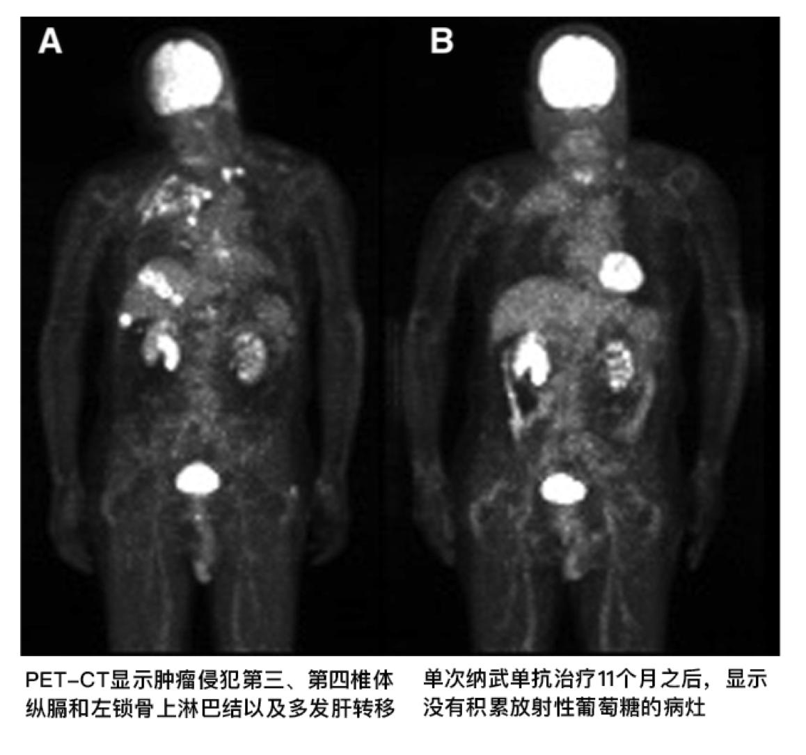 一针癌细胞清零,PD-1和PD-L1能治肺癌吗