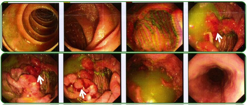 同为腹水，命运迥异
