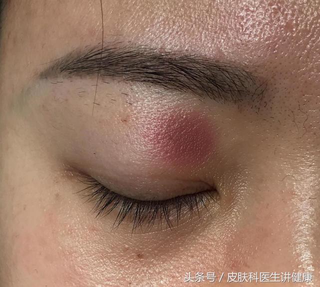 甲硝唑凝胶可以治神经性皮炎吗,神经性皮炎克林霉素甲硝唑