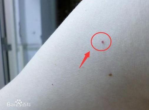 身体内的斑块怎么体检,身体各个部位出现斑块是怎么了