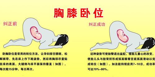 怀孕30周胎位不正头朝上怎么办,过了32周孕妇胎位还能调整吗