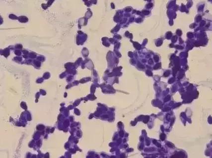 阴道假丝酵母菌感染什么症状,阴道假丝酵母菌感染症状