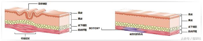 注射除皱案例,了解如何注射除皱