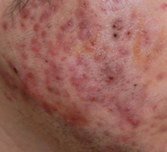 班赛祛痘吗,用班赛会爆痘吗