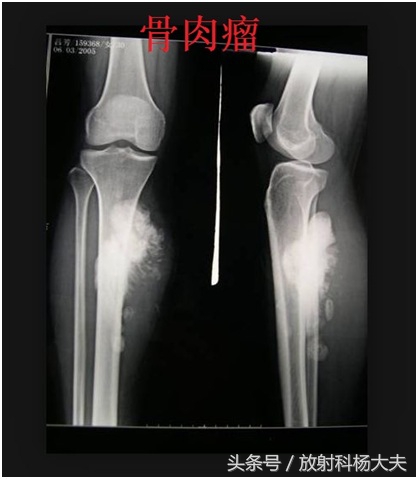 和骨肉瘤相似的病,骨肉瘤罕见病