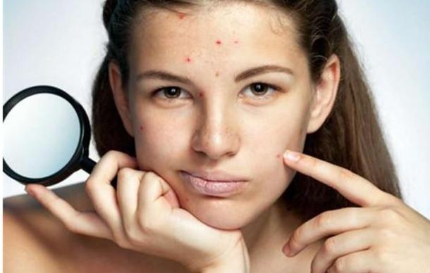 脸上长痘痘痘印怎么快速消除,男生脸上痘印痘坑怎么快速消除