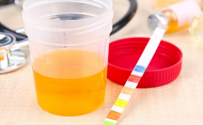 尿蛋白2+需要激素治疗吗,iga肾病吃激素多久尿蛋白降