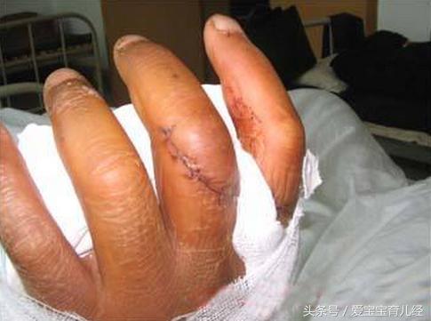 妈妈一时疏忽大意,导致4岁男童3根手指“骨折”!