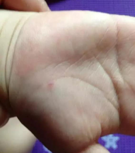 预防手足口病家里要怎么消毒,认识手足口病和怎样预防手足口病