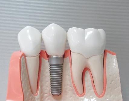 先天性缺牙原因及治疗,缺牙怎么办需要根管治疗吗