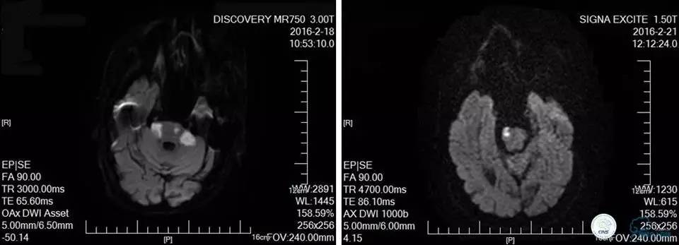 颅内动脉狭窄介入治疗研究,颅内血管cta副作用