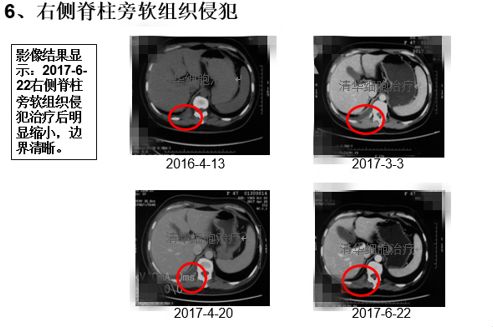 肺鳞癌能用nk细胞疗法吗,肺腺癌nkt治疗成功案例
