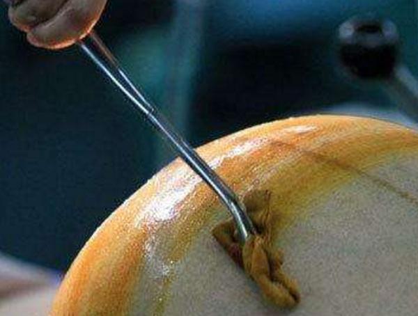 32岁的孕妈妈顺产好还是剖腹产好,孕妈在哪些情况下建议剖腹产