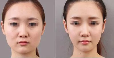 打完瘦脸针你们后悔了吗,打了三次瘦脸针想告诉你这些真相