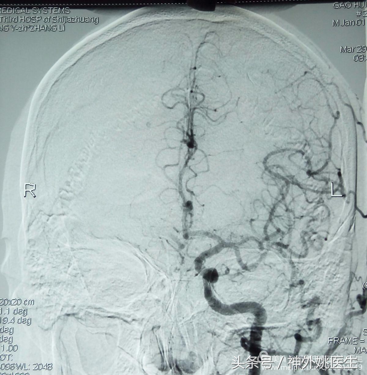 颈内动脉狭窄可以做内膜剥脱术吗,颈内动脉内膜剥脱手术指征