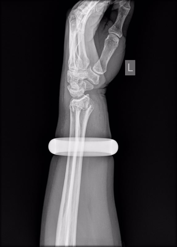 雪天摔倒手腕骨折按摩后肿得更厉害阿姨狠心砸碎2万元玉镯