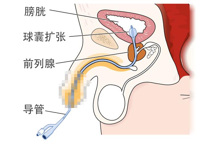 老年人拔尿管后尿不出来怎么回事,刚拔了尿管怎么更好恢复排尿功能