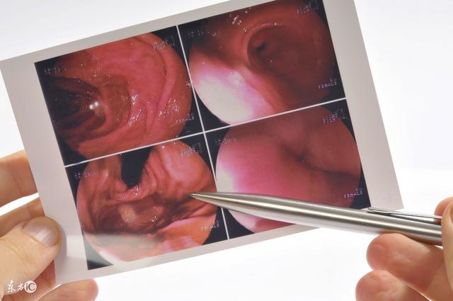 胃镜检查前后的注意事项,胃镜检查幽门螺旋杆菌准确吗