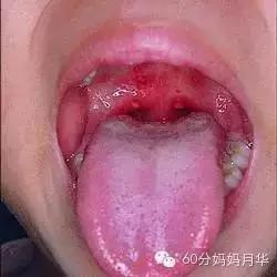 宝宝得了疱疹性咽峡炎不要慌,宝宝得疱疹性咽峡炎的推拿手法