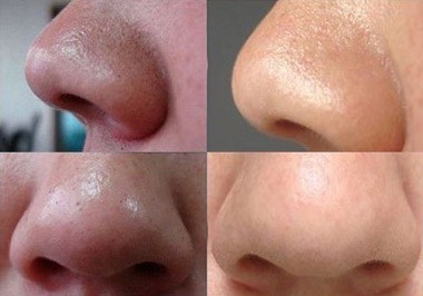 鼻尖上有黑头是怎么回事,鼻尖挤出黑头留下一个坑