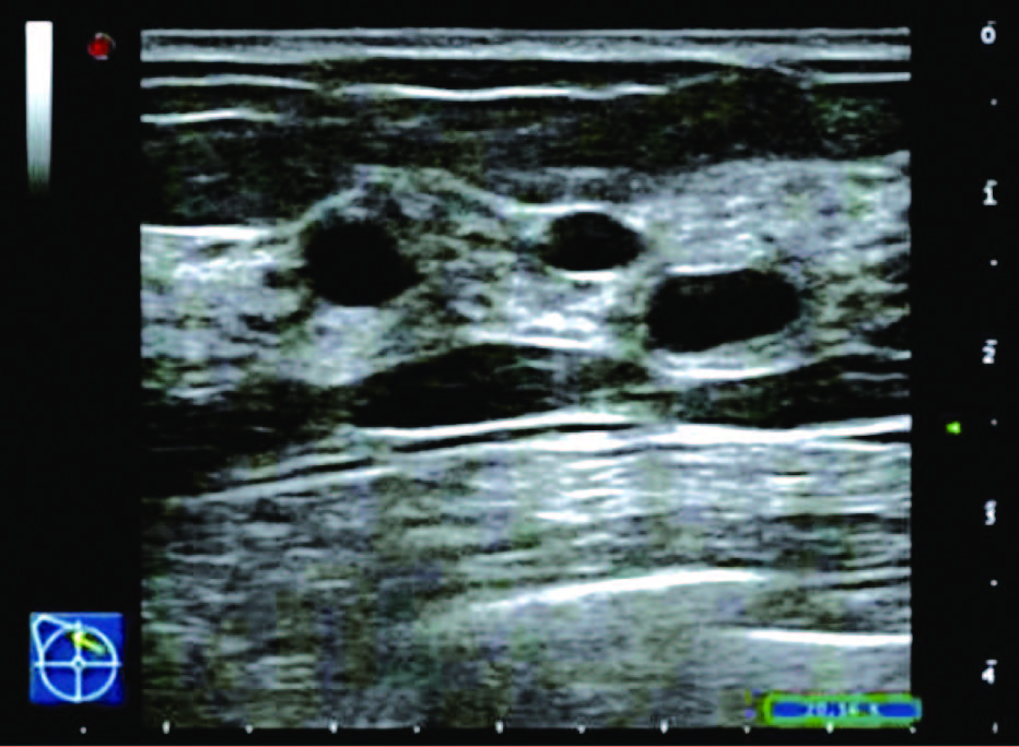 乳腺增生3级结节严重吗,女性乳腺增生怎么治最好