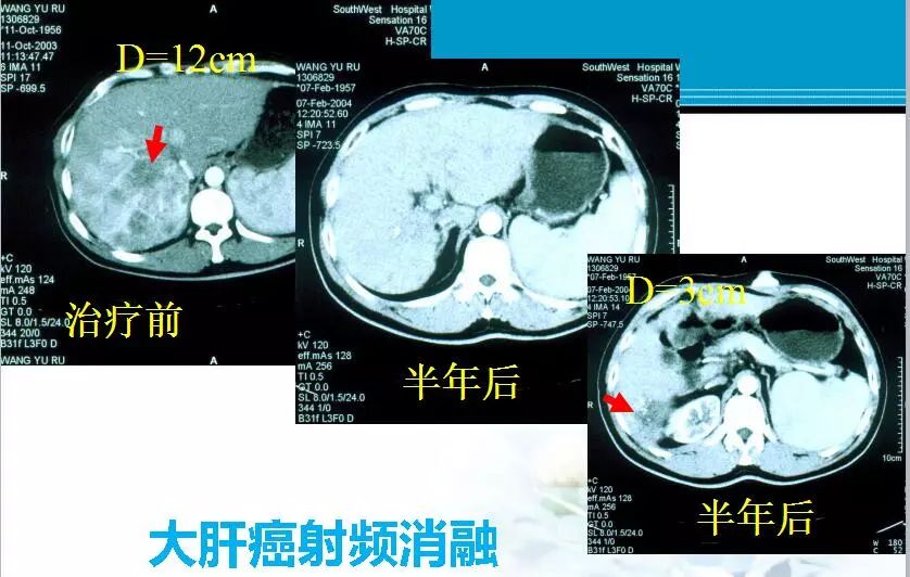 胆管肿瘤射频消融术,肿瘤射频消融厂家