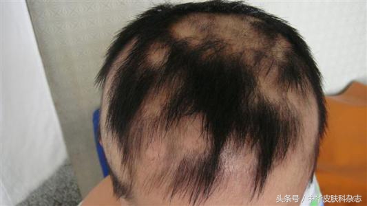 梅毒斑秃脱发,怎么分辨是梅毒性脱发还是斑秃