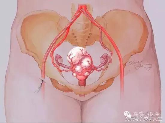 她有痛经炎症、子宫肌瘤病，曾无缘当妈妇科疾病不注意会终身后悔