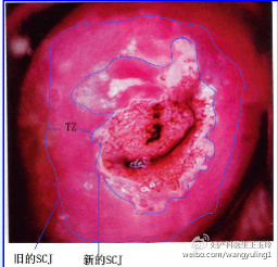 治疗“宫颈糜烂”,这个药被滥用了很多年