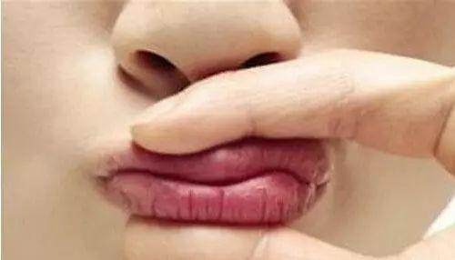 宝宝嘴唇上干裂怎么办最有效,宝宝嘴唇干裂原因及治疗方法