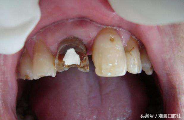 小孩牙齿根管治疗危害,根管治疗牙齿松动了能恢复吗