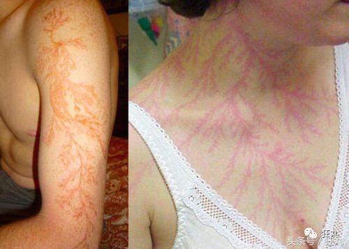 被闪电击中的人会怎么样,被闪电击中得到永生